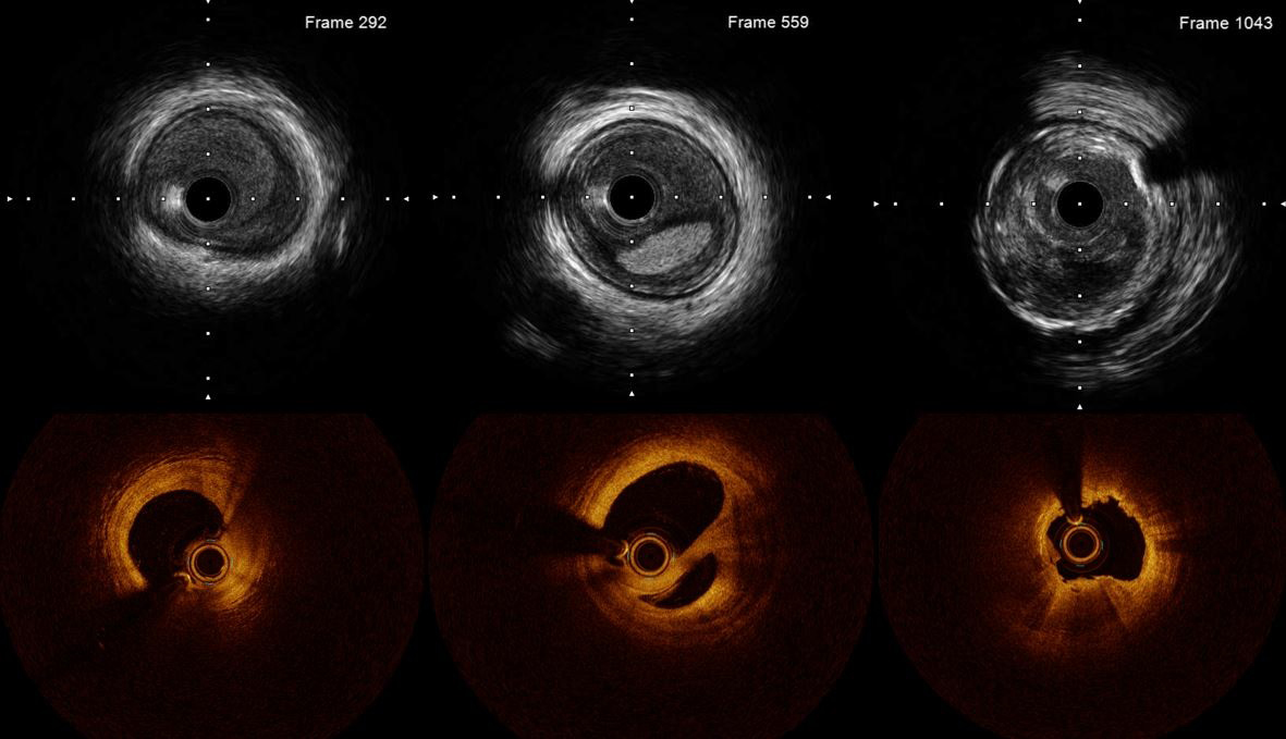 Intravascular Imaging To Inform PCI Should Be Routine: ACC ...